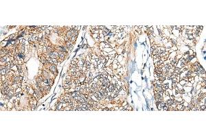 Immunohistochemistry of paraffin-embedded Human gastric cancer tissue using NADK2 Polyclonal Antibody at dilution of 1:40(x200) (NADK2 抗体)