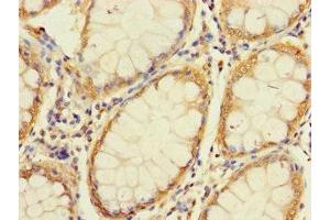 Immunohistochemistry of paraffin-embedded human colon cancer using ABIN7166269 at dilution of 1:100 (UNC93A 抗体  (AA 374-415))
