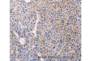 Immunohistochemistry of Human liver cancer using ADCY1 Polyclonal Antibody at dilution of 1:60 (ADCY1 抗体)