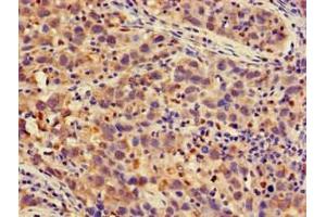 Immunohistochemistry of paraffin-embedded human pancreatic cancer using ABIN7164956 at dilution of 1:100 (PSMA4 抗体  (AA 148-184))