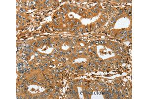 Immunohistochemistry of Human lung cancer using RAP1A Polyclonal Antibody at dilution of 1:45 (RAP1A 抗体)