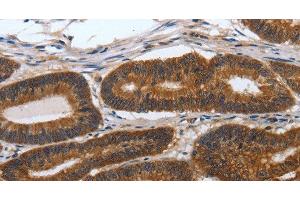 Immunohistochemistry of paraffin-embedded Human colon cancer tissue using PDCD7 Polyclonal Antibody at dilution 1:60 (PDCD7 抗体)