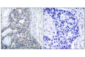 Immunohistochemical analysis of paraffin-embedded human breast carcinoma tissue using Stathmin 1 (phospho-Ser37) antibody (E011225). (Stathmin 1 抗体  (pSer37))