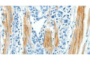 Immunohistochemistry of paraffin-embedded Human gastic cancer using CAV3 Polyclonal Antibody at dilution of 1:30 (Caveolin 3 抗体)