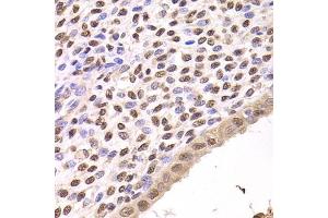 Immunohistochemistry of paraffin-embedded human adenomyosis using FKBP4 Antibody (ABIN5973289) at dilution of 1/200 (40x lens). (FKBP4 抗体)