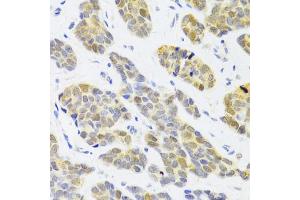 Immunohistochemistry of paraffin-embedded human breast cancer using RFC4 Antibody (ABIN5973195) at dilution of 1/100 (40x lens). (RFC4 抗体)
