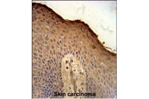 ISM1 Antibody (C-term) (ABIN651237 and ABIN2840147) immunohistochemistry analysis in formalin fixed and paraffin embedded human skin carcinoma followed by peroxidase conjugation of the secondary antibody and DAB staining. (ISM1 抗体  (AA 435-464))