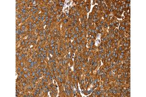Immunohistochemistry of Human liver cancer using RASSF3 Polyclonal Antibody at dilution of 1:35 (RASSF3 抗体)