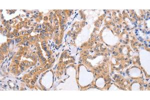 Immunohistochemistry of paraffin-embedded Human thyroid cancer tissue using TGFA Polyclonal Antibody at dilution 1:60 (TGFA 抗体)