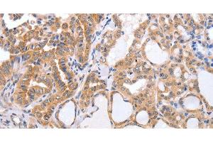Immunohistochemistry of paraffin-embedded Human thyroid cancer tissue using TGFA Polyclonal Antibody at dilution 1:60