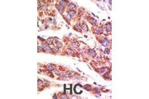 Formalin-fixed and paraffin-embedded human cancer tissue reacted with the primary antibody, which was peroxidase-conjugated to the secondary antibody, followed by AEC staining. (USP12 抗体  (N-Term))