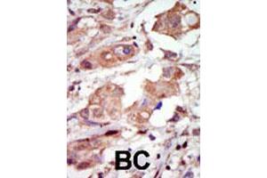 Formalin-fixed and paraffin-embedded human cancer tissue reacted with the MAP3K10 polyclonal antibody  , which was peroxidase-conjugated to the secondary antibody, followed by DAB staining. (MAP3K10 抗体  (C-Term))