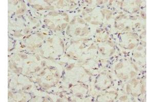 Immunohistochemistry of paraffin-embedded human gastric cancer using ABIN7175358 at dilution of 1:100 (VANGL2 抗体  (AA 1-110))