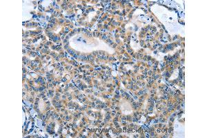 Immunohistochemistry of Human thyroid cancer using ANGPT2 Polyclonal Antibody at dilution of 1:45 (Angiopoietin 2 抗体)