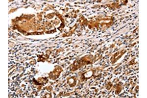 The image on the left is immunohistochemistry of paraffin-embedded Human gastric cancer tissue using ABIN7130598(PGC Antibody) at dilution 1/25, on the right is treated with fusion protein. (PGC 抗体)