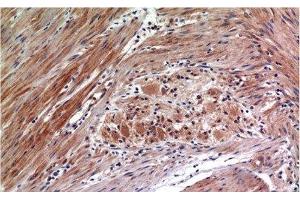 Immunohistochemistry of paraffin-embedded Human colon carcinoma tissue with Phospho-ERK 1/2 (Tyr222/205) Monoclonal Antibody at dilution of 1:200 (ERK1/2 抗体  (pTyr205, pTyr222))