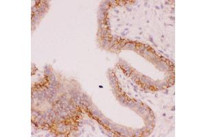 Anti-SLC9A1 Picoband antibody,  IHC(P): Human Mammary Cancer Tissue