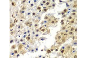 Immunohistochemistry of paraffin-embedded Human liver cancer using SYNCRIP Polyclonal Antibody at dilution of 1:100 (40x lens). (SYNCRIP 抗体)