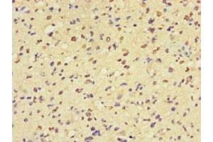 Immunohistochemistry of paraffin-embedded human glioma using ABIN7160057 at dilution of 1:100 (MAP3K8 抗体  (AA 1-300))