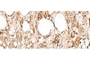 Immunohistochemistry of paraffin-embedded Human breast cancer tissue using FBXW8 Polyclonal Antibody at dilution of 1:65(x200) (FBXW8 抗体)