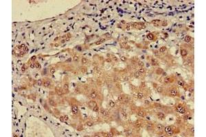 Immunohistochemistry of paraffin-embedded human liver cancer using ABIN7147724 at dilution of 1:100 (CHD5 抗体  (AA 1600-1699))