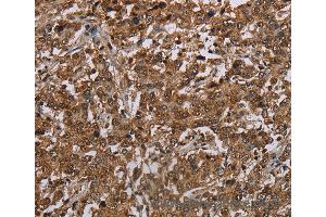 Immunohistochemistry of Human liver cancer using TBX5 Polyclonal Antibody at dilution of 1:35