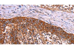 Immunohistochemistry of paraffin-embedded Human cervical cancer using ABI1 Polyclonal Antibody at dilution of 1:40 (ABI1 抗体)