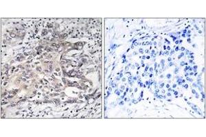 Immunohistochemistry analysis of paraffin-embedded human liver carcinoma tissue, using Cytochrome P450 4X1 Antibody. (CYP4X1 抗体  (AA 251-300))