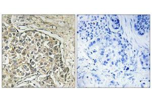 Immunohistochemistry analysis of paraffin-embedded human lung carcinoma tissue using ARSD antibody. (Arylsulfatase D 抗体  (Internal Region))