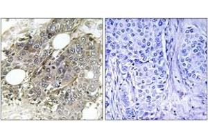 Immunohistochemistry analysis of paraffin-embedded human breast carcinoma tissue, using TGF beta Receptor III (Ab-842) Antibody. (TGFBR3 抗体)