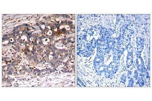 Immunohistochemical analysis of paraffin-embedded human breast carcinoma tissue, using Shc1 (Ab-427) antibody (E021317). (SHC1 抗体)