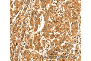 Immunohistochemistry of Human esophagus cancer using DIRAS1 Polyclonal Antibody at dilution of 1:52 (DIRAS1 抗体)