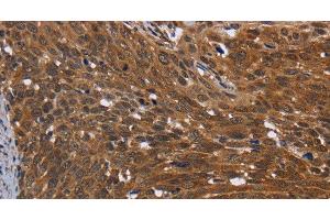 Immunohistochemistry of paraffin-embedded Human cervical cancer using FHIT Polyclonal Antibody at dilution of 1:30 (FHIT 抗体)