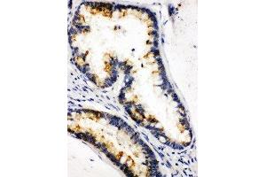 Anti-Kallikrein 6 antibody, IHC(P) IHC(P): Human Intestinal Cancer Tissue (Kallikrein 6 抗体  (C-Term))