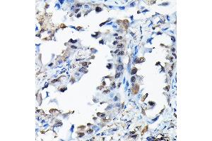 Immunohistochemistry of paraffin-embedded human lung cancer using RBBP9 Rabbit pAb (ABIN6129095, ABIN6146752, ABIN6146753 and ABIN6220638) at dilution of 1:200 (40x lens). (RBBP9 抗体  (AA 1-186))