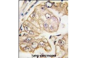 Formalin-fixed and paraffin-embedded human lung carcinoma tissue reacted with VGFR3 Monoclonal Antibody (ABIN387818 and ABIN2843906) , which was peroxidase-conjugated to the secondary antibody, followed by DAB staining. (FLT4 抗体)