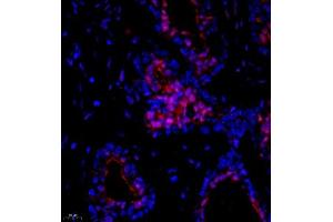 Immunofluorescence of paraffin embedded human breast cancer using Suv39h2 (ABIN7075771) at dilution of 1:2000 (400x lens) (SUV39H2 抗体)