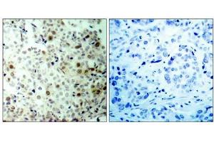 Immunohistochemical analysis of paraffin- embedded human breast carcinoma tissue, using CDK2 (phospho-Thr160) antibody (E011133). (CDK2 抗体  (pThr160))