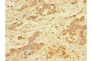 Immunohistochemistry of paraffin-embedded human pancreatic cancer using ABIN7143770 at dilution of 1:100 (ALG2 抗体  (AA 303-405))