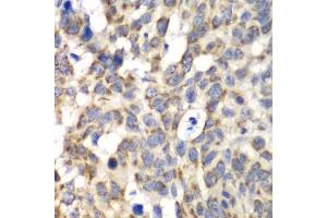 Immunohistochemistry of paraffin-embedded human esophageal cancer using PARN antibody (ABIN5972174) at dilution of 1/100 (40x lens). (PARN 抗体)