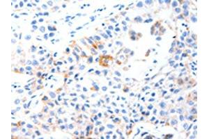 The image on the left is immunohistochemistry of paraffin-embedded Human lung cancer tissue using ABIN7191546(MUC3A Antibody) at dilution 1/60, on the right is treated with synthetic peptide. (MUC3A 抗体)
