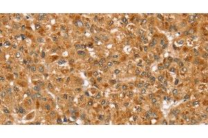 Immunohistochemistry of paraffin-embedded Human liver cancer using STX3 Polyclonal Antibody at dilution of 1:35 (STX3 抗体)