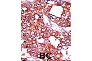 Formalin-fixed and paraffin-embedded human cancer tissue reacted with CDC25A (phospho T506) polyclonal antibody  which was peroxidase-conjugated to the secondary antibody followed by AEC staining. (CDC25A 抗体  (pThr507))