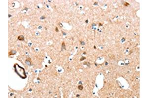 The image on the left is immunohistochemistry of paraffin-embedded Human brain tissue using ABIN7189570(AARS Antibody) at dilution 1/50, on the right is treated with synthetic peptide. (AARS 抗体)