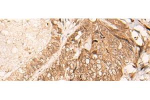 Immunohistochemistry of paraffin-embedded Human colorectal cancer tissue using HIPK3 Polyclonal Antibody at dilution of 1:60(x200) (HIPK3 抗体)