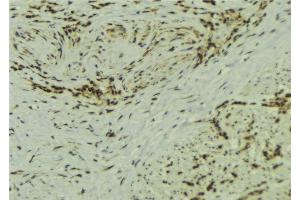 ABIN6273106 at 1/100 staining Human breast cancer tissue by IHC-P. (SS18L1 抗体)