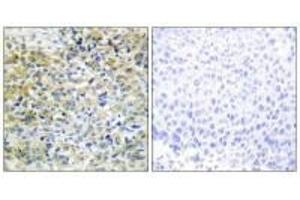 Immunohistochemistry analysis of paraffin-embedded human liver carcinoma tissue using CARKL antibody. (SHPK 抗体  (N-Term))