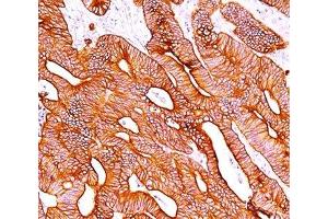 IHC staining of colon carcinoma with pan Cytokeratin antibody cocktail AE1 + AE3. (pan Keratin 抗体)