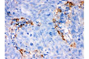 FCGRT was detected in paraffin-embedded sections of human lung cancer tissues using rabbit anti- FCGRT Antigen Affinity purified polyclonal antibody at 1 μg/mL. (FcRn 抗体  (AA 56-291))