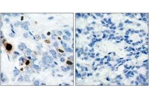 Immunohistochemistry analysis of paraffin-embedded human breast carcinoma, using Histone H3. (Histone H3.1 抗体  (pSer10))